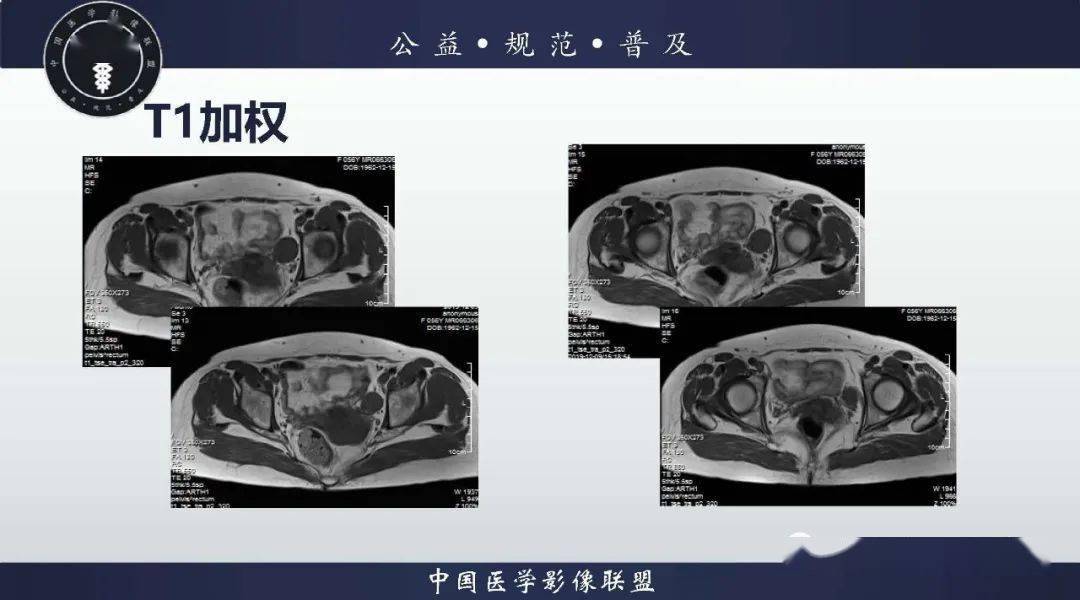 神經纖維瘤病（腹膜后及女性病例）醫學影像特征與分析
